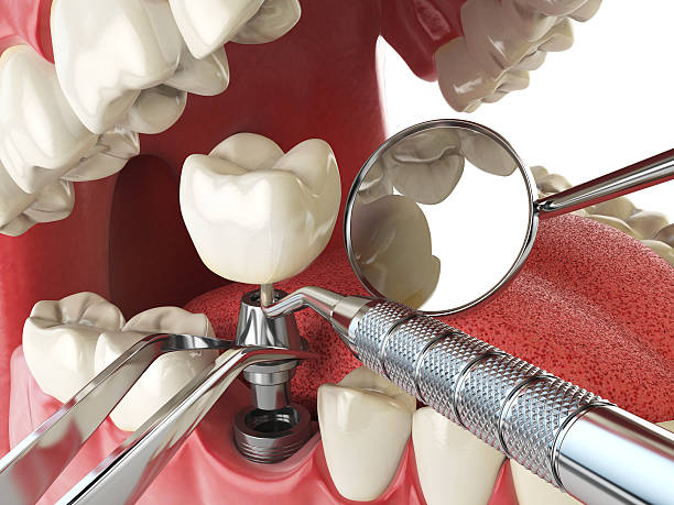 Best Knocked-Out Tooth (Avulsed Tooth) Treatment in Oak Creek, WI